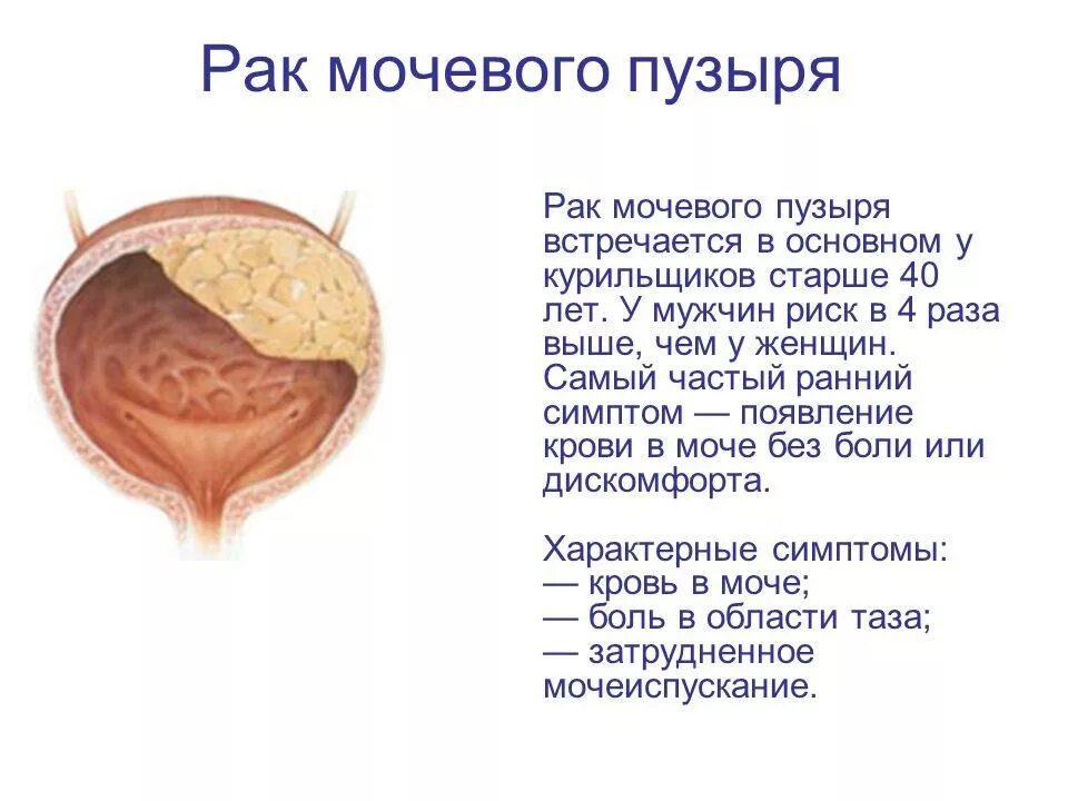 Терпеть мочевой долго. Треугольник Льето мочевого пузыря. Объемное образование мочевого пузыря с-r. Злокачественные новообразования мочевого пузыря. Симптомы злокачественного новообразования мочевого пузыря:.