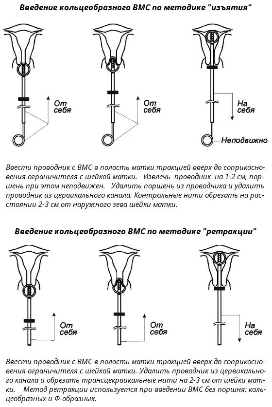 Введение вмс. Методики введения спирали. Техника введения внутриматочной спирали. Техника постановки ВМС спирали.