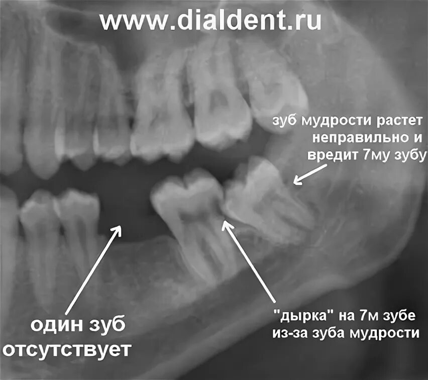 Почему зубы мудрости так называются. Зуб мудрости (3-й моляр, восьмерка). Прорезается зуб мудрости на верхней челюсти.