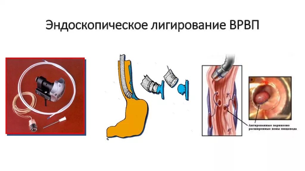 Цирроз печени кровотечение пищевода. Операция лигирование вен пищевода. Лигирование склерозирование ВРВП. Лигирование вен пищевода при циррозе печени. Лигирование сосудов пищевода.