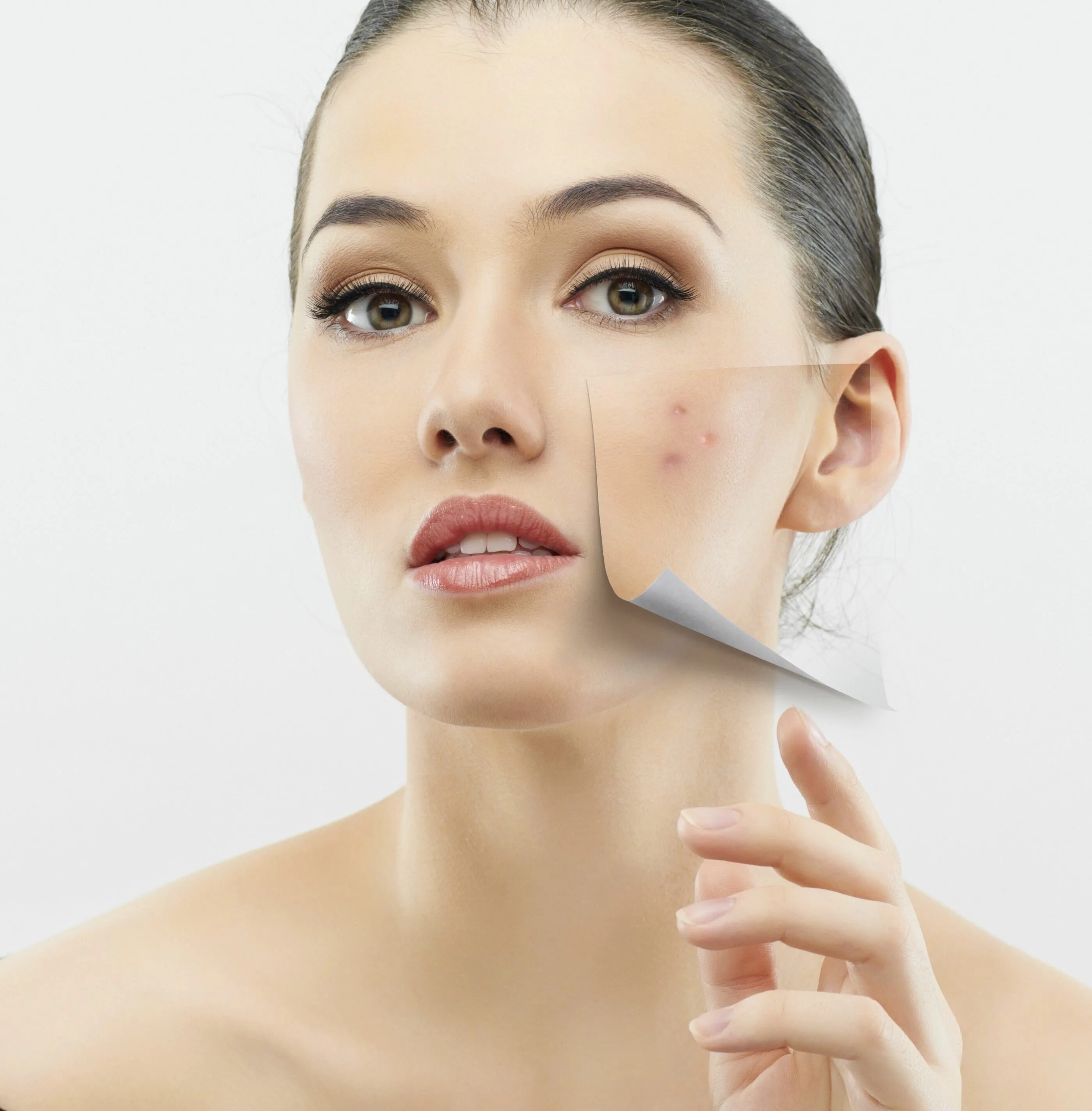 Девушка с проблемной кожей. Красивое лицо без прыщей. Acne program