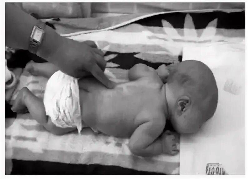 Рефлекс переса у новорожденных. Рефлекс переса у новорожденных. Рефлекс галанта у новорожденных. Рефлекс переса и галанта. Рефлекс переса и галанта.