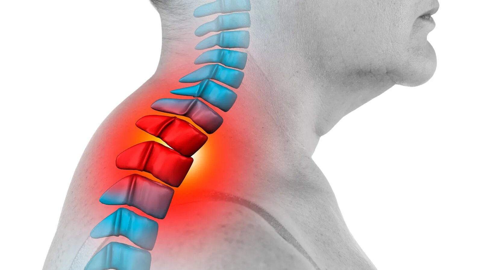 Болит позвоночник при нажатии. Лордоз шейного отдела отдела. Что такое сколиоз шейного отдела позвонка. Вдовий горб искривление позвоночника.