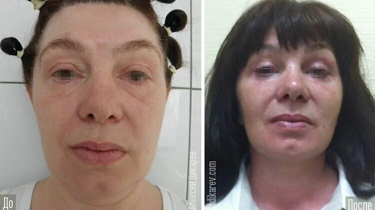 7 подтяжка. Акромегалия фото до и после. Эндоскопическая подтяжка лица фото до и после. Акромегалия фото до и после женщин. Акромегалия до и после операции.