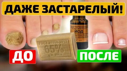 Йод на ногти ног