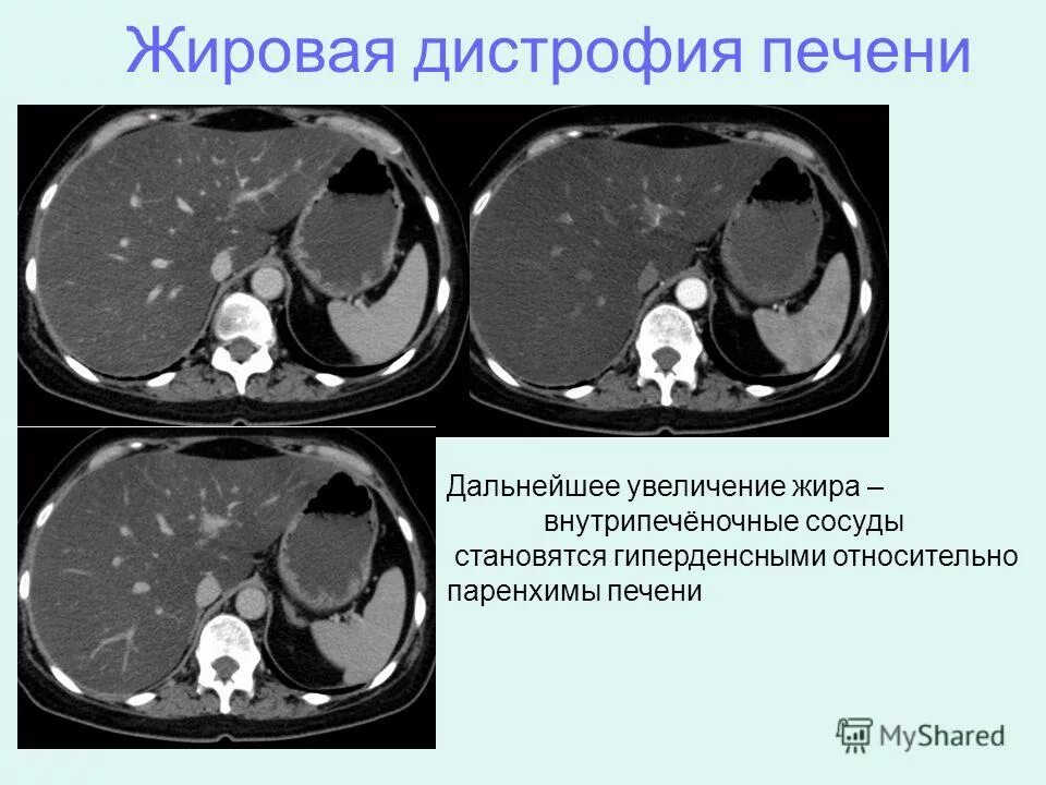 Признаки дистрофии печени