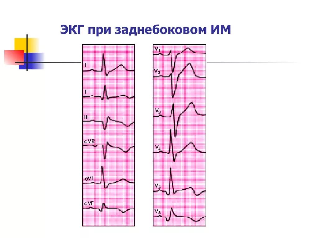 Болезни на экг. Трансмуральная ишемия на ЭКГ. Заднебоковой инфаркт миокарда ЭКГ. Электрокардиограмма при ишемической болезни. Субэндокардиальная ишемия на ЭКГ.