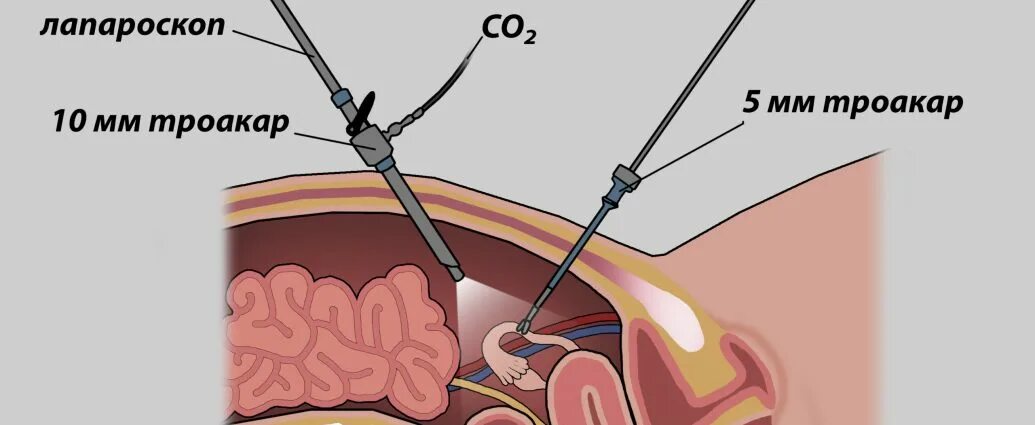 Лапароскопия внематочная. Лапароскопия диагностическая лапароскопия. Операция внематочной беременности лапароскопии. Эндометриоидная киста лапароскопия. Месячные после удаления трубы
