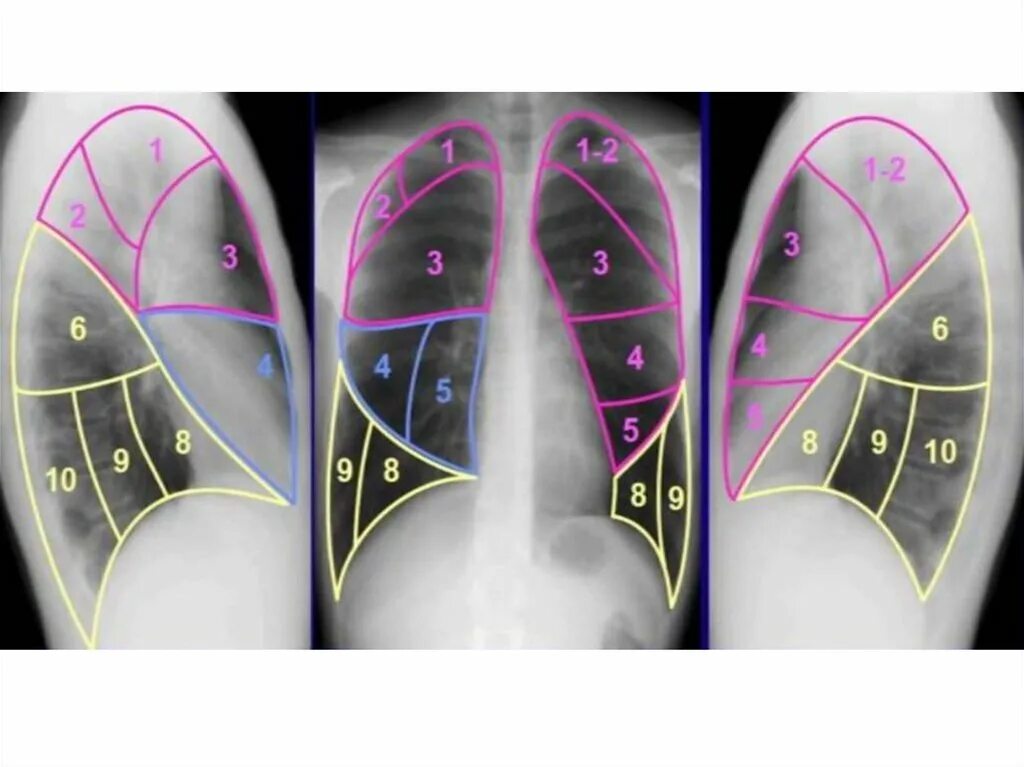 3 доли правого легкого. 1 2 6 Сегменты легкого. 4-5 Сегменты легкого. Сегментарное строение легких рентген. S 10 сегмент легких.