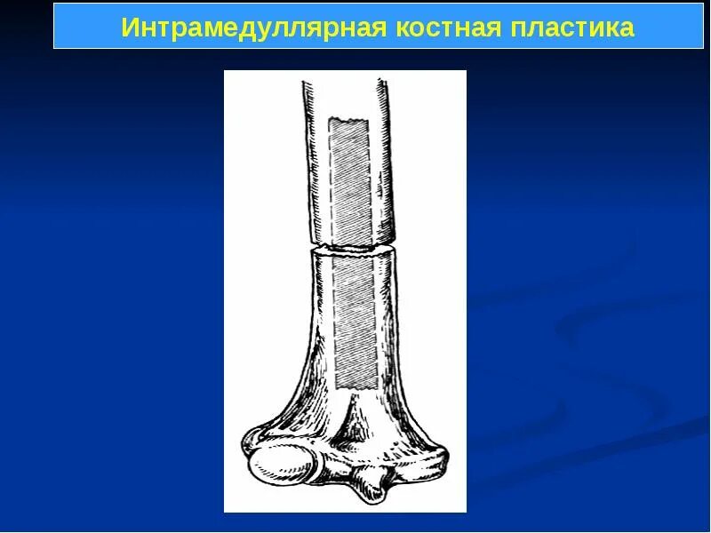 Костная пластика состоит. Остеопластика костная пластика. Костная пластика по. Костная пластика по богданову. Костная пластика по чаклину.