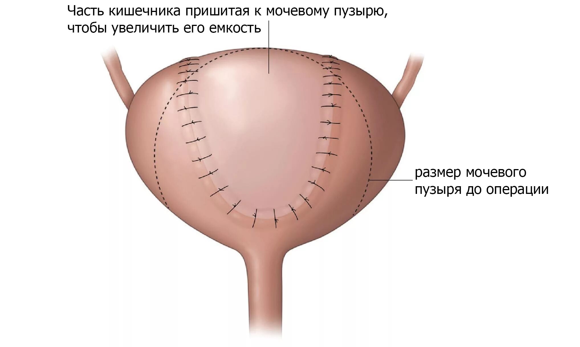 Удалили мочевой пузырь мужчине. Аугментационная цистопластика. Мочевой пузырь. Аугментация мочевого пузыря. Ампутация мочевого пузыря.