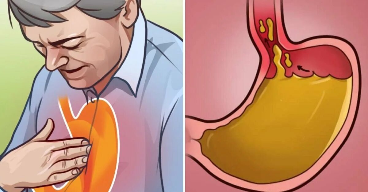Изжога картинки. Изжога мультяшный. Изжога причины у мужчин после 60