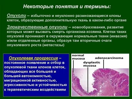 Опухоли термины