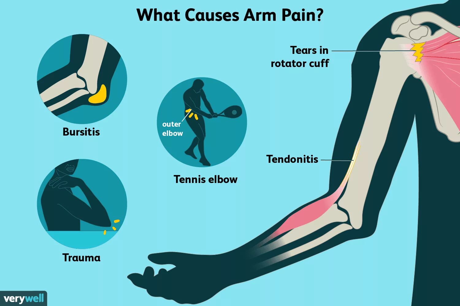 Arm Pain. Arm in Arm.