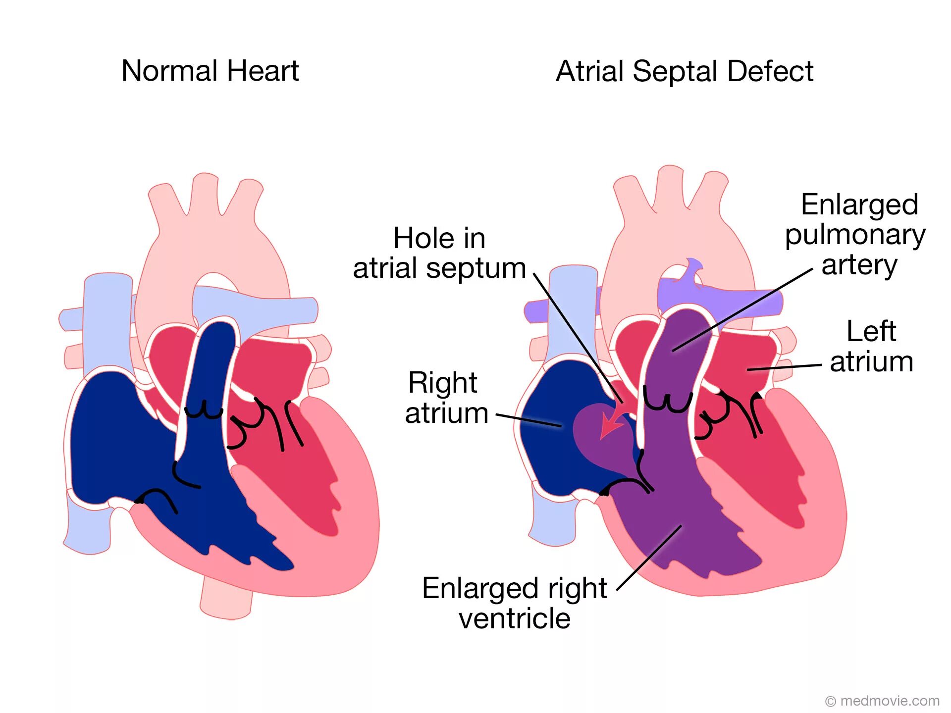 Врожденные пороки сердца дефект межпредсердной перегородки. Atrial septal defect. atrial septal defect (asd). дефект межпредсердной перегородки гемодинамика.