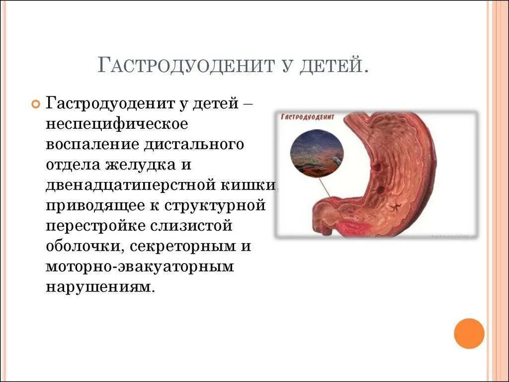Что такое дуоденит желудка. Острый язвенный гастродуоденит. хронический гастродуоденит клинические проявления. нодулярный гастродуоденит. поверхностный дуоденит желудка.