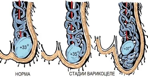 Варикозное расширение левого яичка. Вена левого яичка