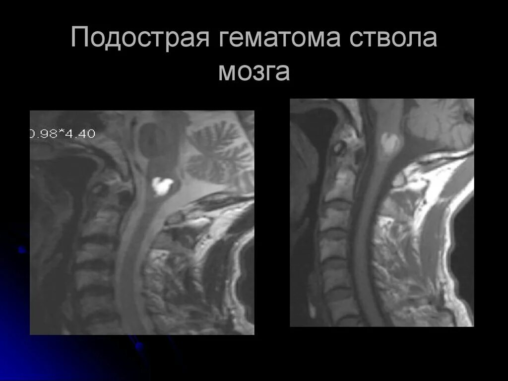 Кровоизлияние ствола мозга. Гематома в стволе головного мозга. Мальформация ствола мозга. Гематома ствола мозга кт.