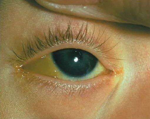 Иктеричность склер у новорожденных. Почему глаза желтоватого