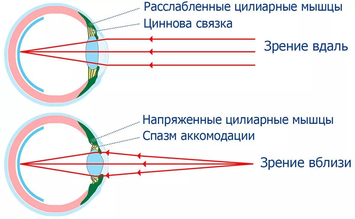 В аккомодации участвуют. Схема аккомодации хрусталика. Аккомодационный аппарат глаза схема. Спазм аккомодации схема. Механизм аккомодации глаза схема.