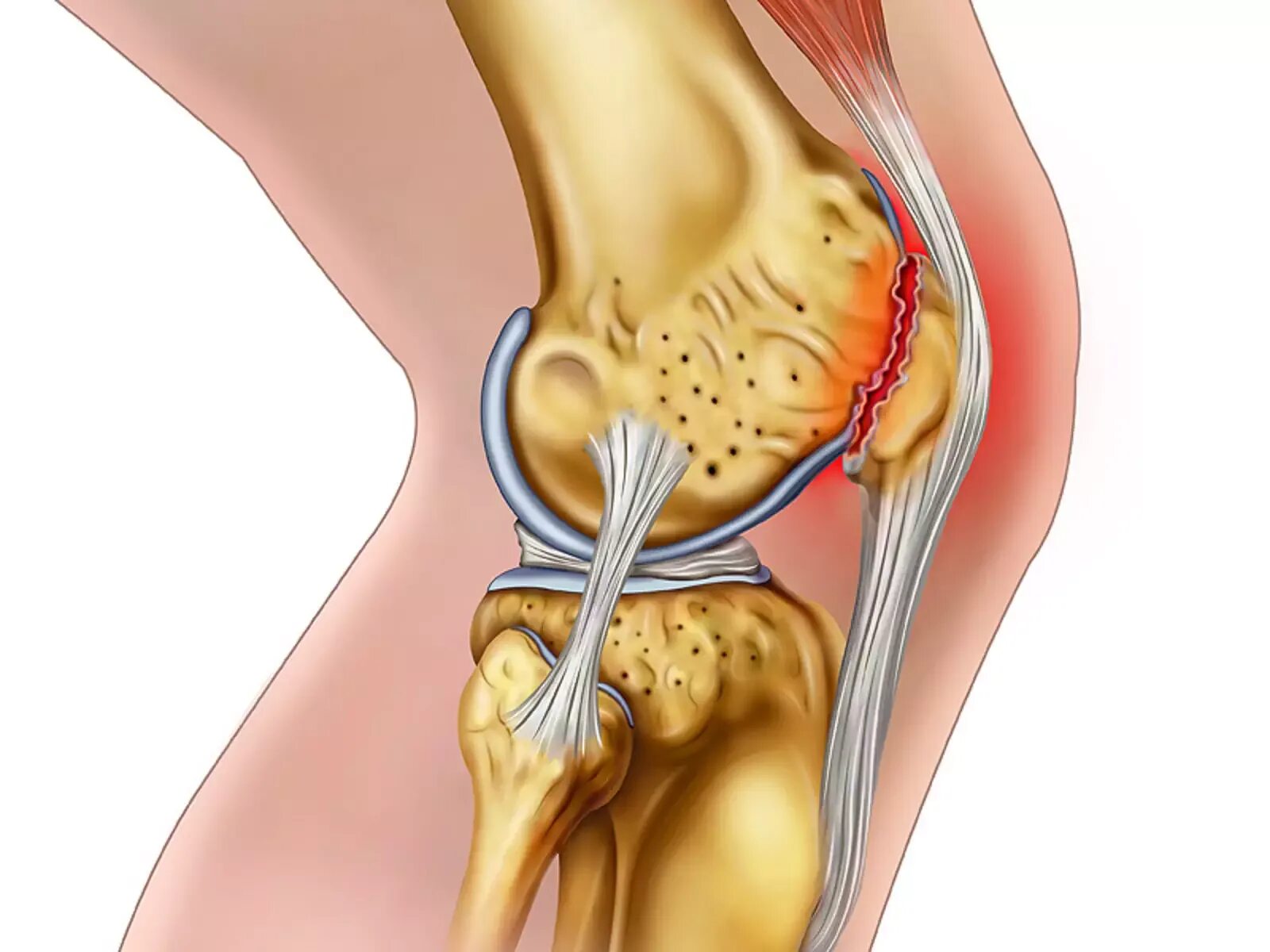Трещина болит. Разрыв мениска коленного. Внутренний менисцит коленного сустава. Мениск коленной чашечки что это такое.