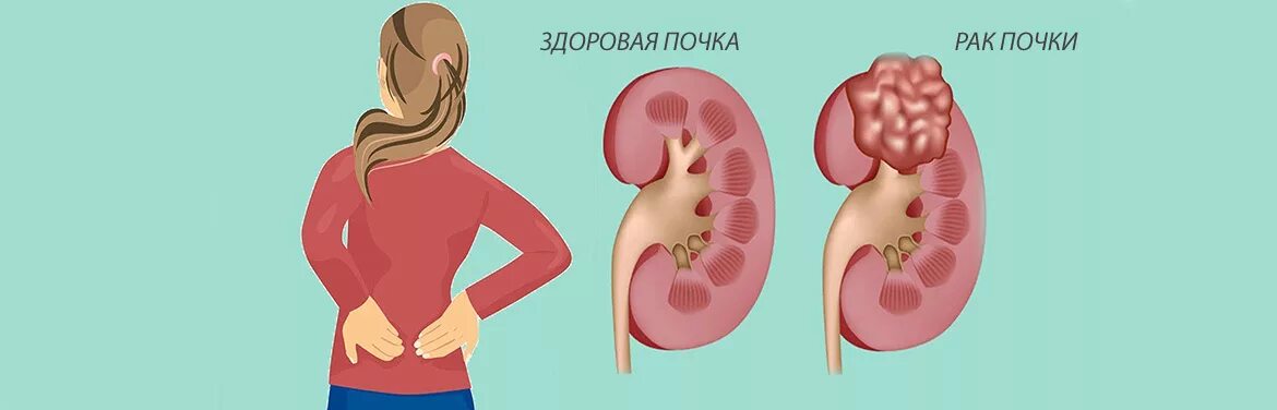 Здоровая почка и почка с опухолью. Здоровые почки и нарушенные. Воспаление почек симптомы у женщин. Рак почки причины