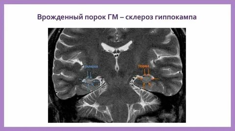 Единичные очаги в печени