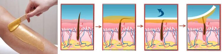 Схема нанесения воска. Нанесение против роста волос. Правильное нанесение воска на кожу. Удаленный волос с корнем воском. Депиляция воском против роста или по росту