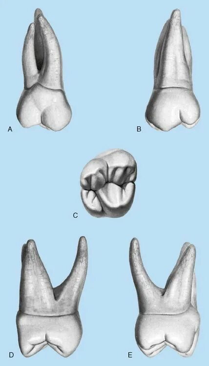 Ретинированный дистопированный зуб. Клампы с надписью molar. Third molars. Third molars. Зуб мудрости и тройничный нерв.