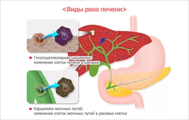 Терапия рака печени. Первичные злокачественные опухоли печени. Злокачественные гепатоцеллюлярные опухоли:. Гепатоцеллюлярная карцинома вид. Гепатоцеллюлярная карцинома печени.