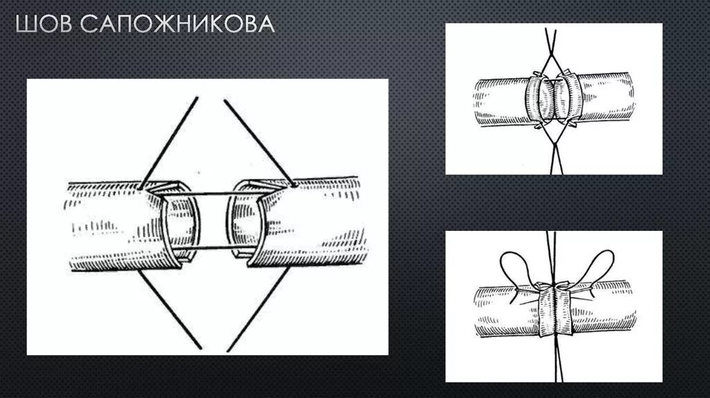 Х образный шов. Сосудистый шов по Соловьеву. П образный шов.