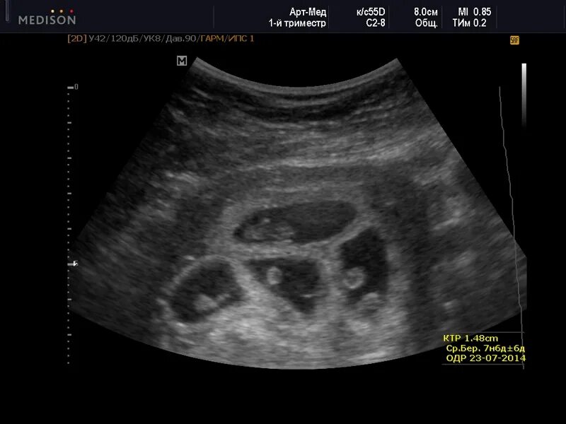 двойня на узи 6 недель акушерских. узи 6 недель беременности двойня. узи плодное яйцо 6 недель двойня. фото узи многоплодной беременности 5 недель. двойня на 5 неделе беременности.