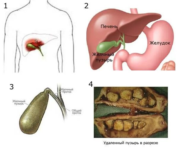 Желчный пузырь как лечить в домашних условиях. Голотопия желчного пузыря. Жёлчный пузырь патология с загибом. Дисформия желчного пузыря. Строение человека внутренние органы желчный пузырь.
