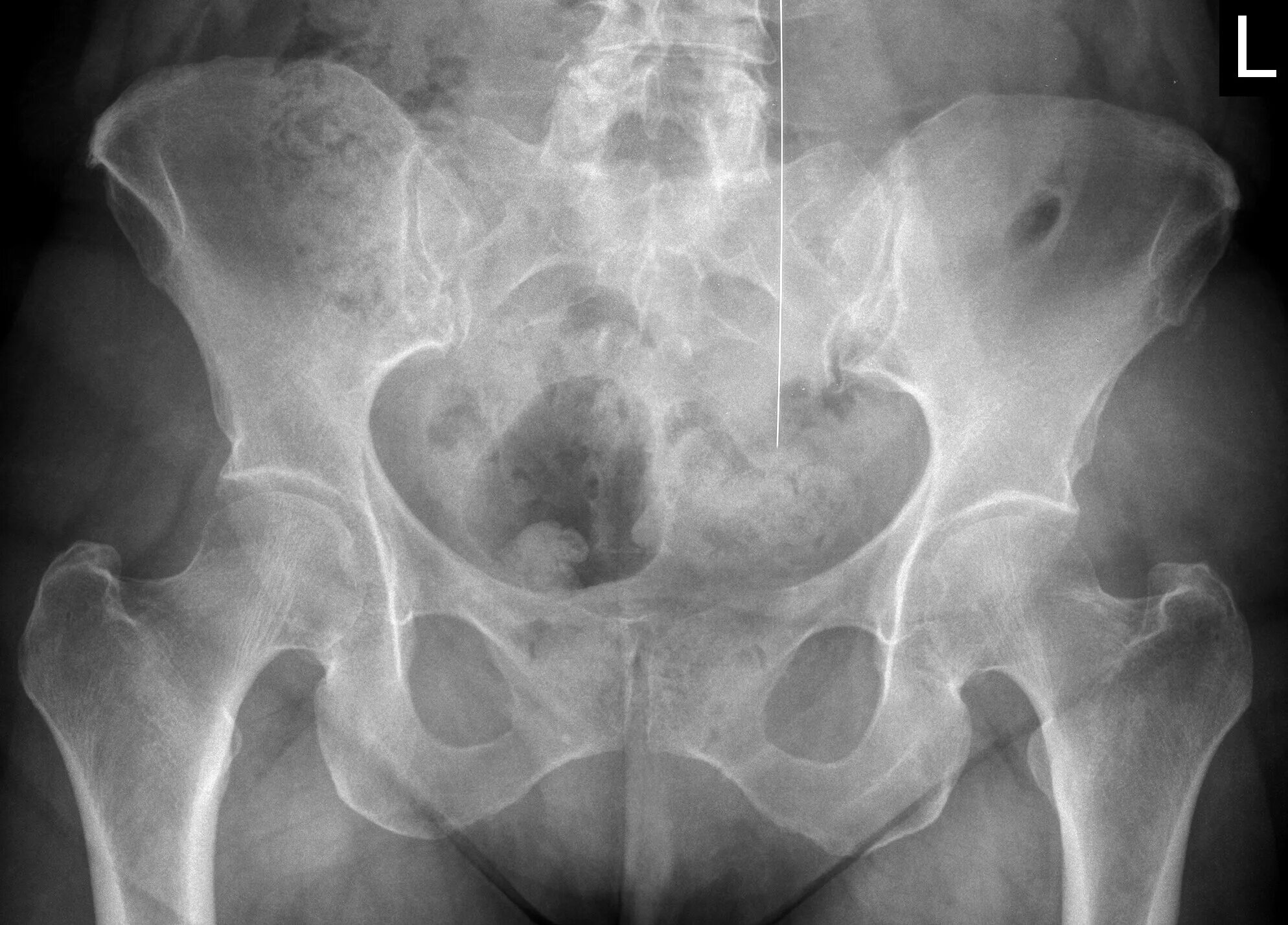 Кт подвздошной кости. Метастазы костей таза рентген. Метастатическое поражение костей таза рентген. Рентген подвздошной кости.