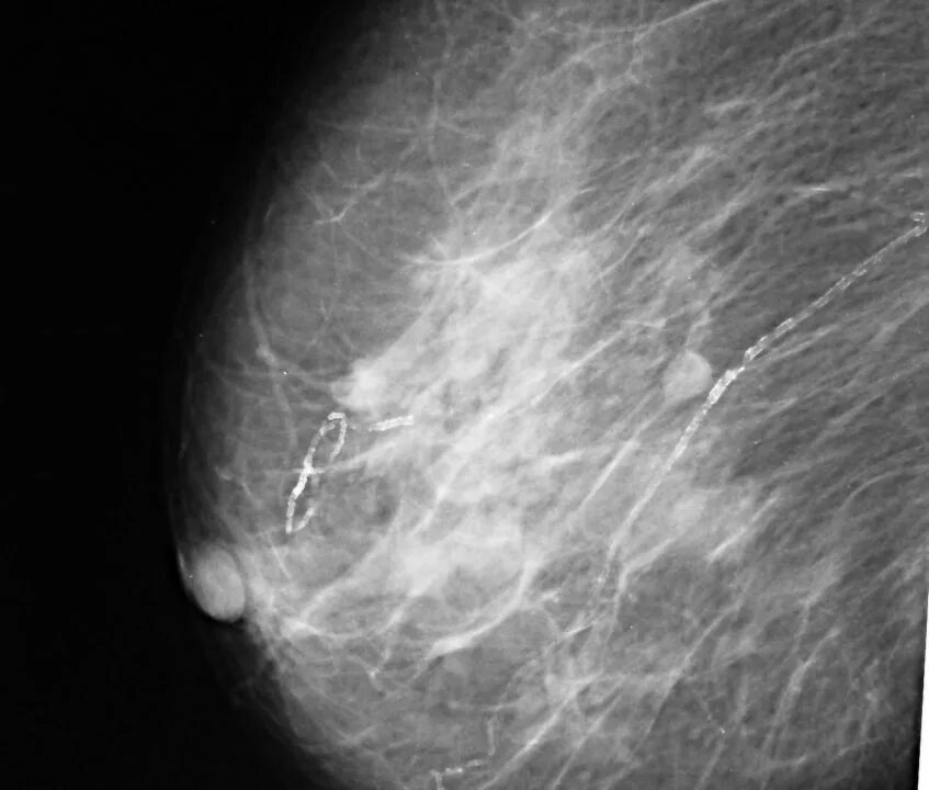 Маммография фиброаденома. Фиброаденома молочной железы рентген. Мелкокистозный фиброаденоматоз. Диффузный фиброаденоматоз.