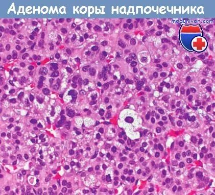 Узловая гиперплазия надпочечника кт. Аденома надпочечника макропрепарат. Феохромоцитома доброкачественная. Артериальная гипертензия пароксизмального типа. Опухоль коркового слоя надпочечников.