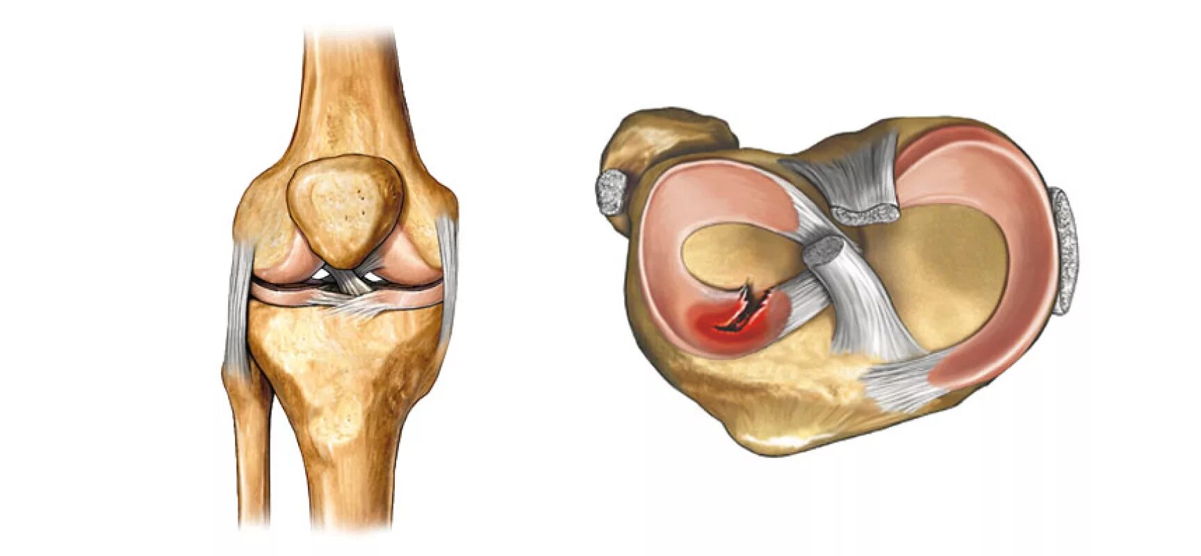 Связка мениска колена. Медиальный мениск коленного сустава анатомия. Разрыв медиального мениска коленного сустава. Мениск коленного сустава мкб 10. Латеральный мениск коленного сустава.