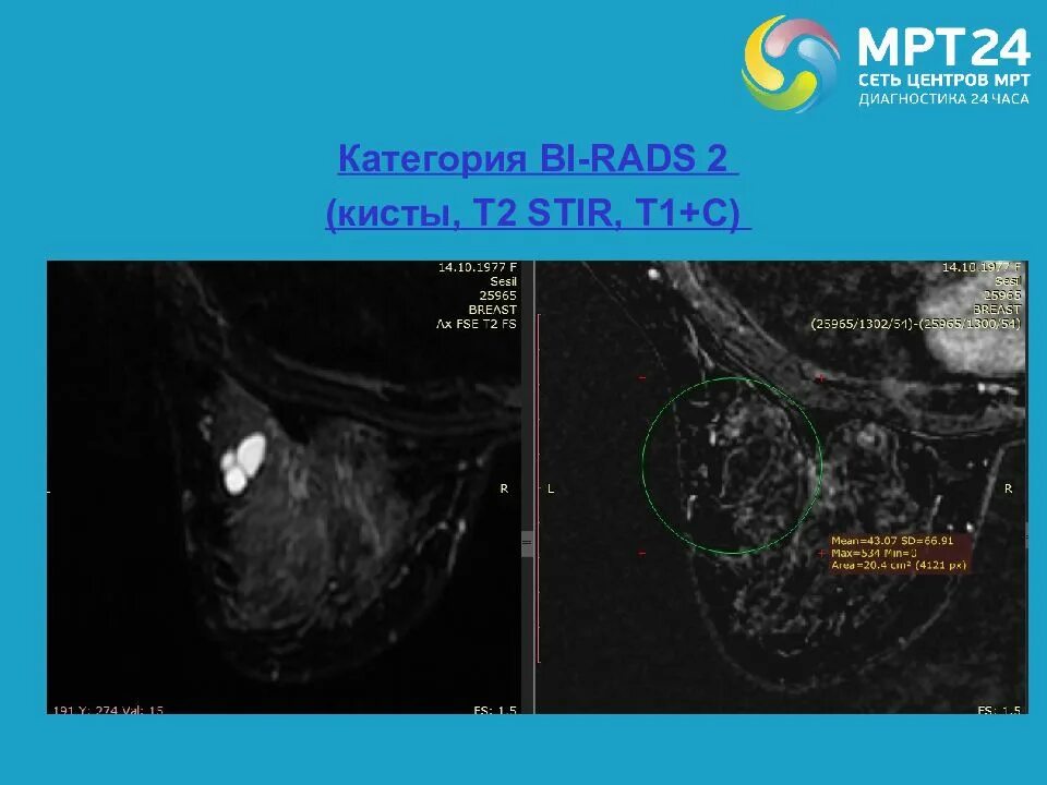 Категория bi rads 2 молочных желез. Тип накопления контраста молочной железы. Типы кривых накопления контрастного вещества. Bi rads 2. Киста 1 категории по bi rads.