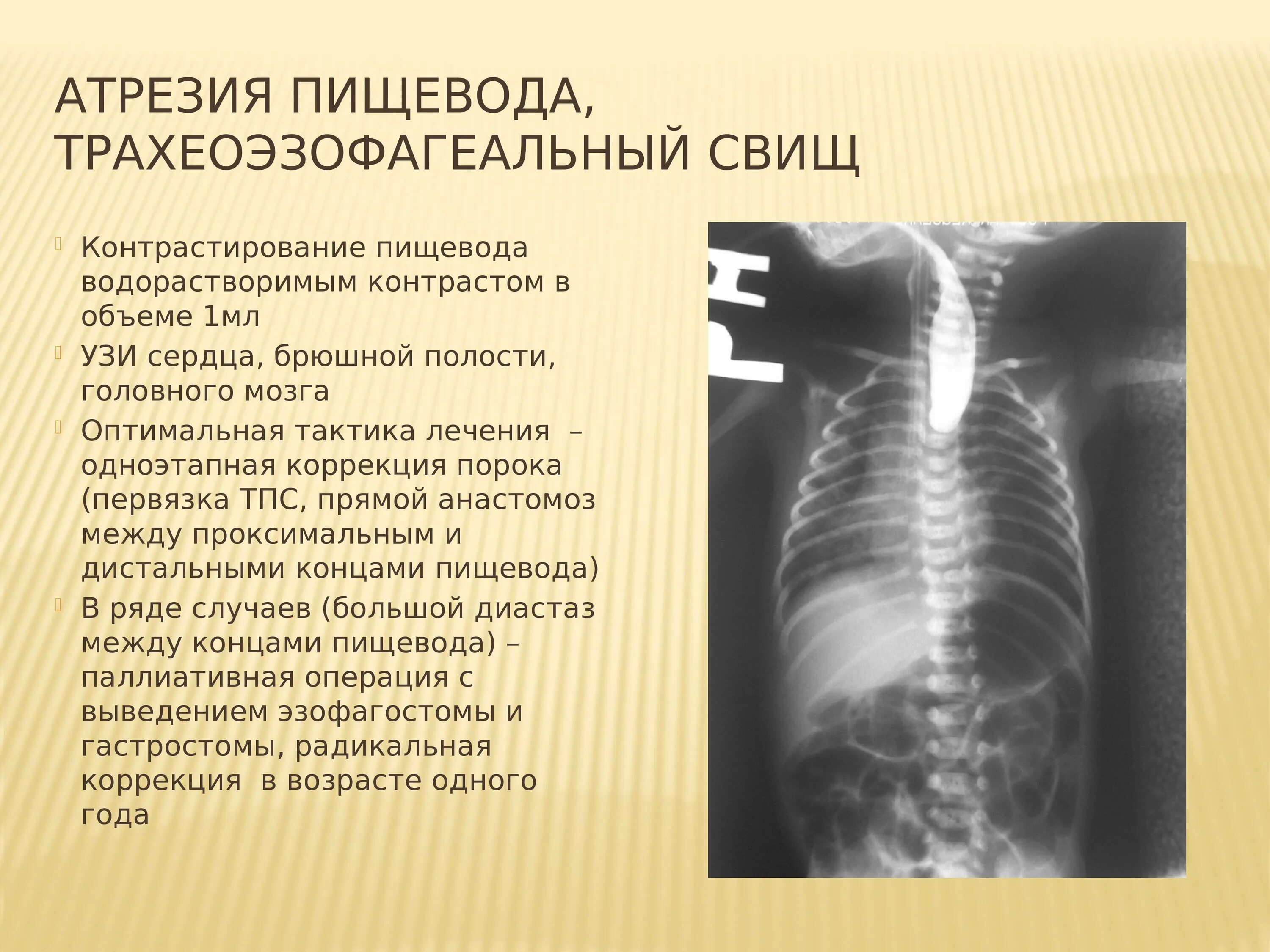Атрезия пищевода. Атрезия пищевода (безсвищевая форма) рентген. дифференциальный диагноз атрезии пищевода. атрезия пищевода рентген. врожденная атрезия пищевода.