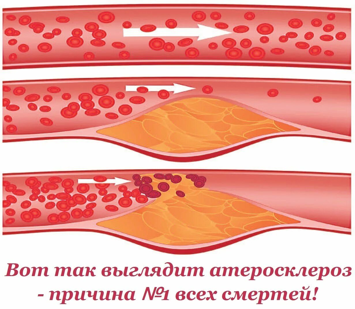 Атеросклероз (закупорка кровеносных сосудов). Закупорка сосудов холестерином.