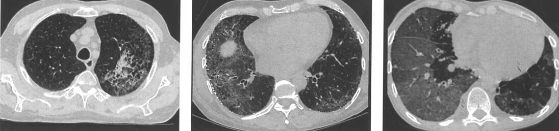 Идиопатический легочный фиброз кт. Интерстициальный пневмофиброз на кт. Идиопатический пневмофиброз. Диффузный пневмофиброз кт.