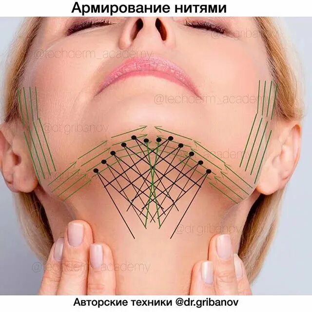 Нити аптос для подтяжки лица. Тредлифтинг золотые нити. Векторное армирование лица. Нитевой лифтинг (мезонити). Армирование лица мезонитями.