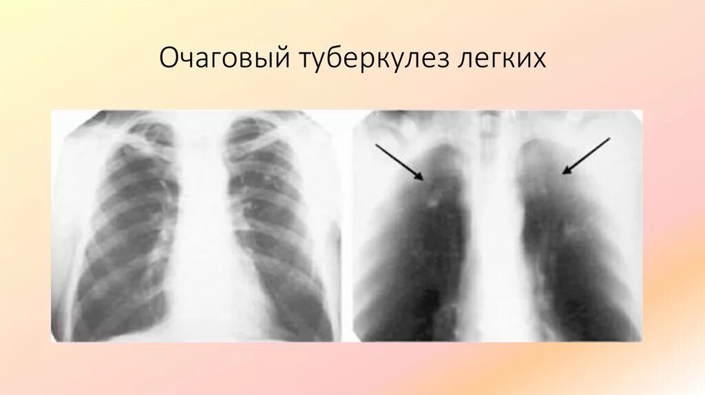 Картина очаговых. Фиброзно очаговый туберкулез рентген. Мелкоочаговый туберкулез легких рентген. Рентгеносемиотика туберкулеза легких фтизиатрия. Рентгенодиагностика туберкулеза.