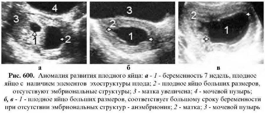 7 неделя не видно эмбриона. Плодное яйцо при беременности 5 6 недель. Плодное яйцо на УЗИ 5 недель. Плодное яйцо на 5-6 неделе беременности. Плодное яйцо на раннем сроке Размеры.