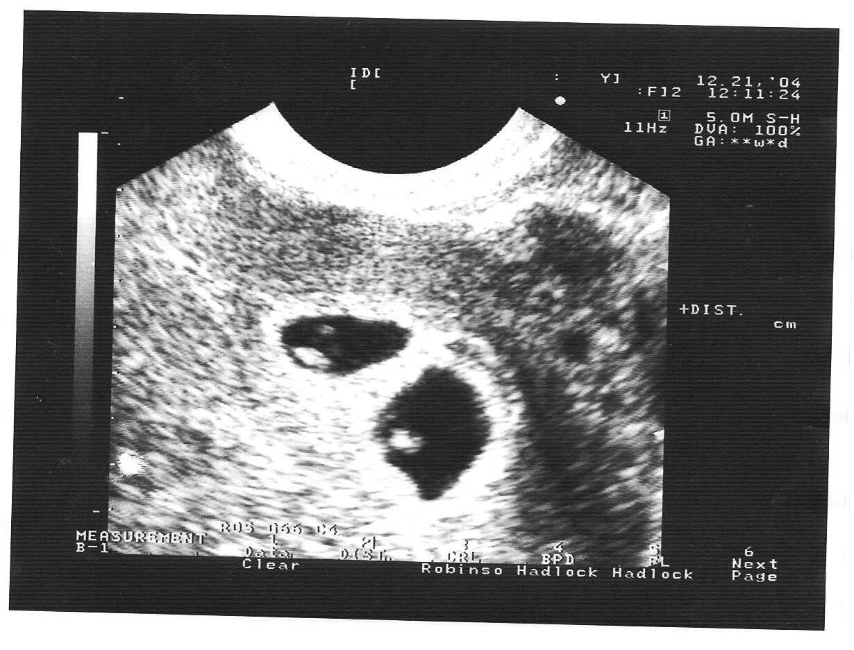 УЗИ двойни на ранних сроках 7 недель беременности. УЗИ 5-7 недель беременности двойня. УЗИ 7 акушерских недель двойня. УЗИ 7-8 недель беременности двойня. Двойня 7 недель