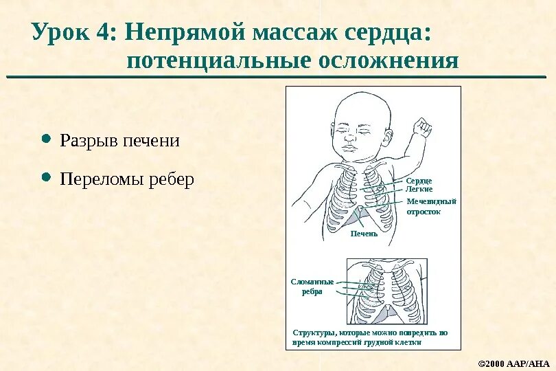 Перелом ребер при непрямом массаже сердца. Перелом ребер при массаже сердца. Сломанные ребра при непрямом массаже сердца. Осложнения при закрытом массаже сердца