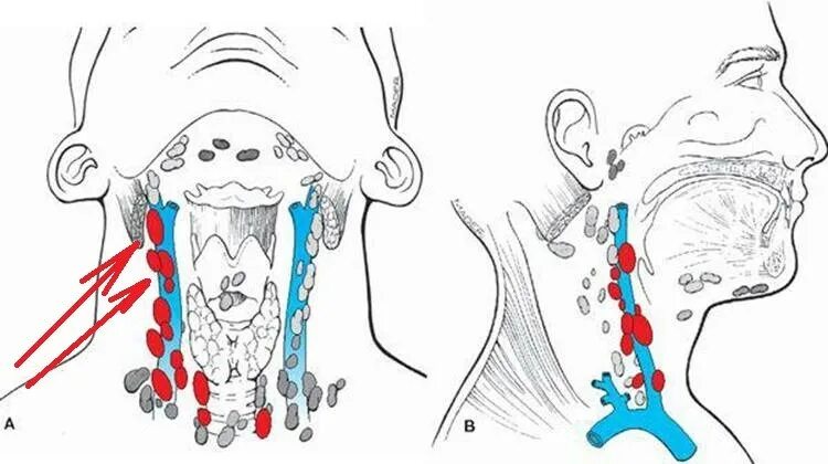 Поднижнечелюстные лимфоузлы воспаление. Подчелюстные лимфоузлы схема. Тонзиллярные лимфоузлы. Лимфоузлы нижнечелюстные воспаление. Лимфоузлы на языке