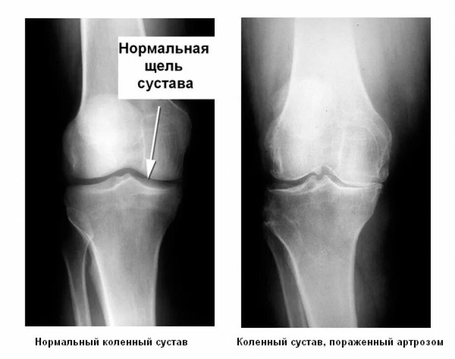 Гонартроз коленного сустава рентген стадии. Деструкция коленного сустава рентген. Гонартроз коленного сустава рентген. Коленный сустав рентген норма.