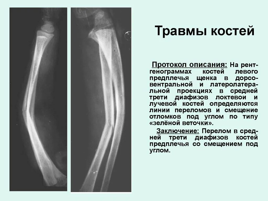 Перелом диафиза локтевой кости рентген. Протокол рентген перелом локтевой кости. Диафазный перелом лучевой кости. Перелом диафиза лучевой кости рентген.