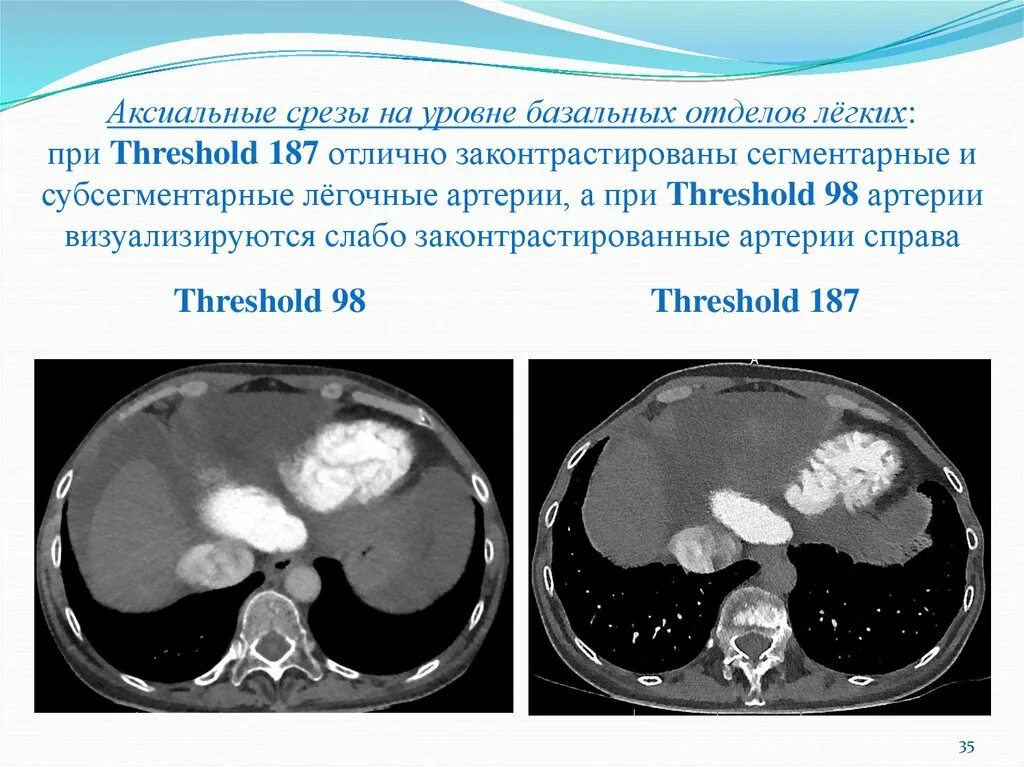 Срезы кт. Срезы кт. Аксиальная кт. Срез грудной клетки мрт. Препонтийная цистерна кт аксиальный срез.